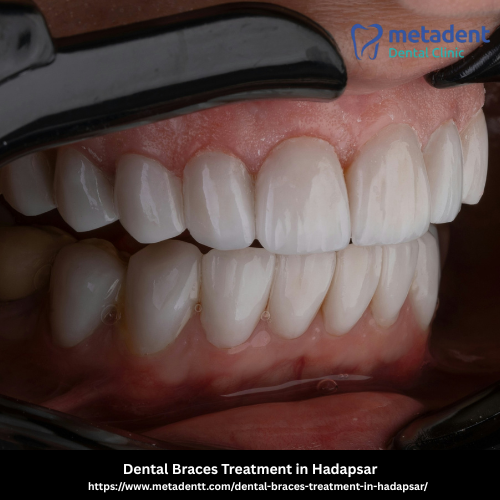 Dental Braces Treatment in Hadapsar