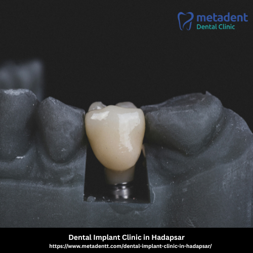Dental Implant Clinic in Hadapsar