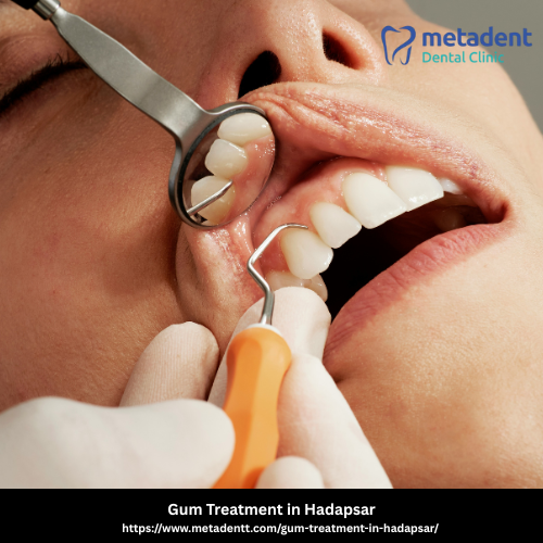 Gum Treatment in Hadapsar