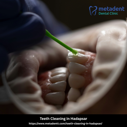 Teeth Cleaning in Hadapsar
