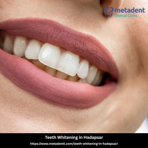 Teeth Whitening in Hadapsar